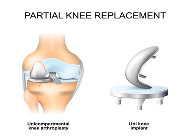 Partial Knee Replacement (PKR)