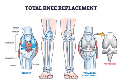 Total Knee Replacement (TKR)